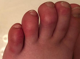 Ayak parmaklarındaki cilt lezyonları da bir Covid-19 belirtisi olabilir