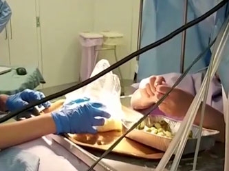 60 yaşındaki kadın, beyin ameliyatı sırasında zeytin dolması yaptı