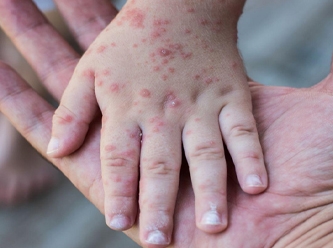 İstanbul'da kızamık için kırmızı alarm!