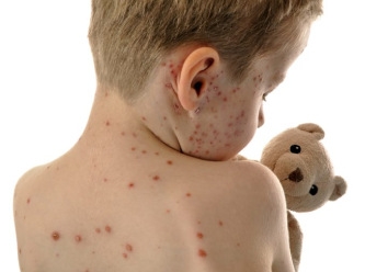 Kızamık hastalığı neden yayılıyor? Salgın endişesi derinleşiyor