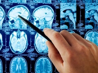 Beyin tümörünü tespit edecek… COVID testi gibi basit ve pratik