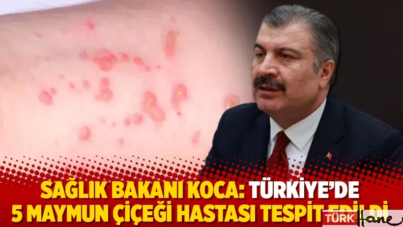 Sağlık Bakanı Koca: Türkiye’de 5 maymun çiçeği hastası tespit edildi