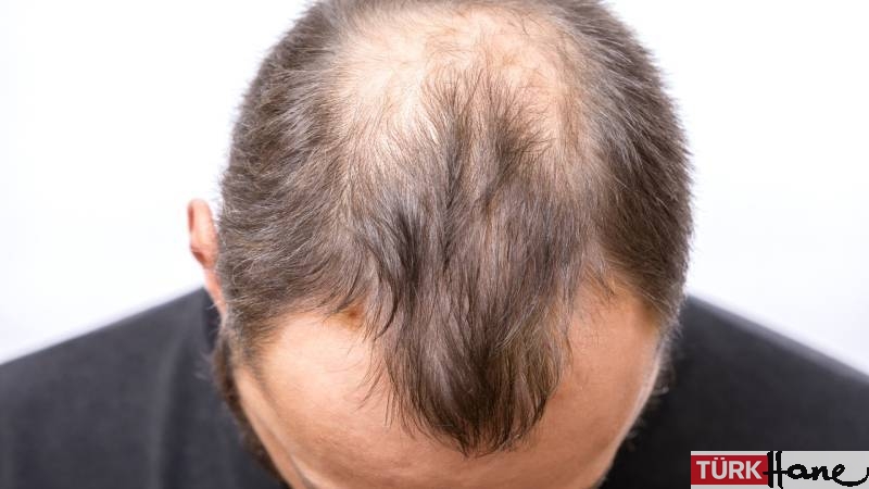 Kelliğin ilacı bulundu, uzmanlar merak edilen soruları yanıtladı: Saç ekimi tarihe mi karışıyor?