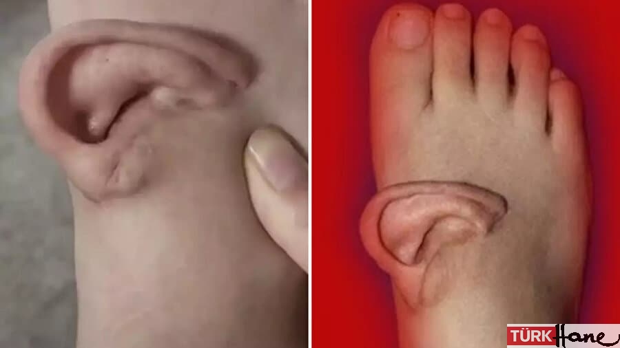 Kulak, ayağa nakledilerek kurtarıldı